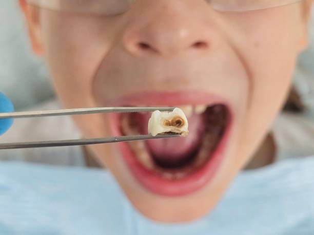 Best Emergency Wisdom Teeth Removal in Shawnee, OK
